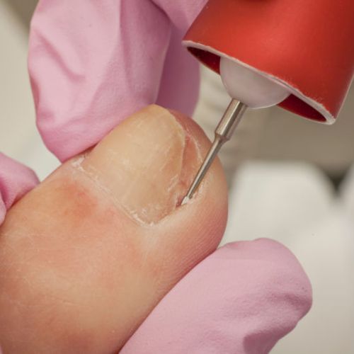 Mobile Foot Care Ottawa